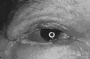 眼角膜发炎可以吃蜜瓜吗,蜜瓜食用指南