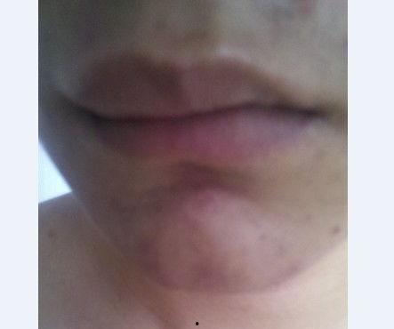 吃角瓜嘴唇肿,吃角瓜嘴唇肿的应急处理与预防攻略